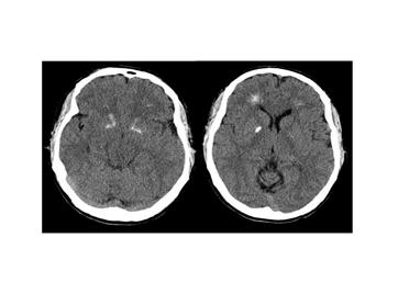 : Brain_computer_tomography_cuts_of_the_patient_with_22q11